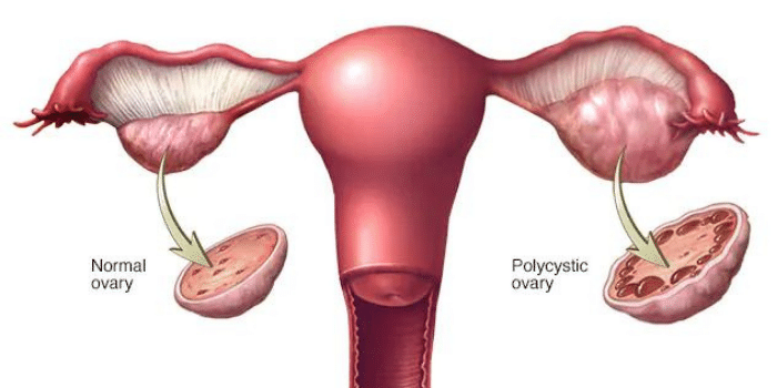 Consecuencias del Sindrome de Ovario Poliquístico